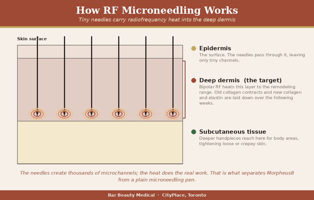 How Morpheus8 RF microneedling works, skin-layer energy depth cross-section | Bar Beauty Medical