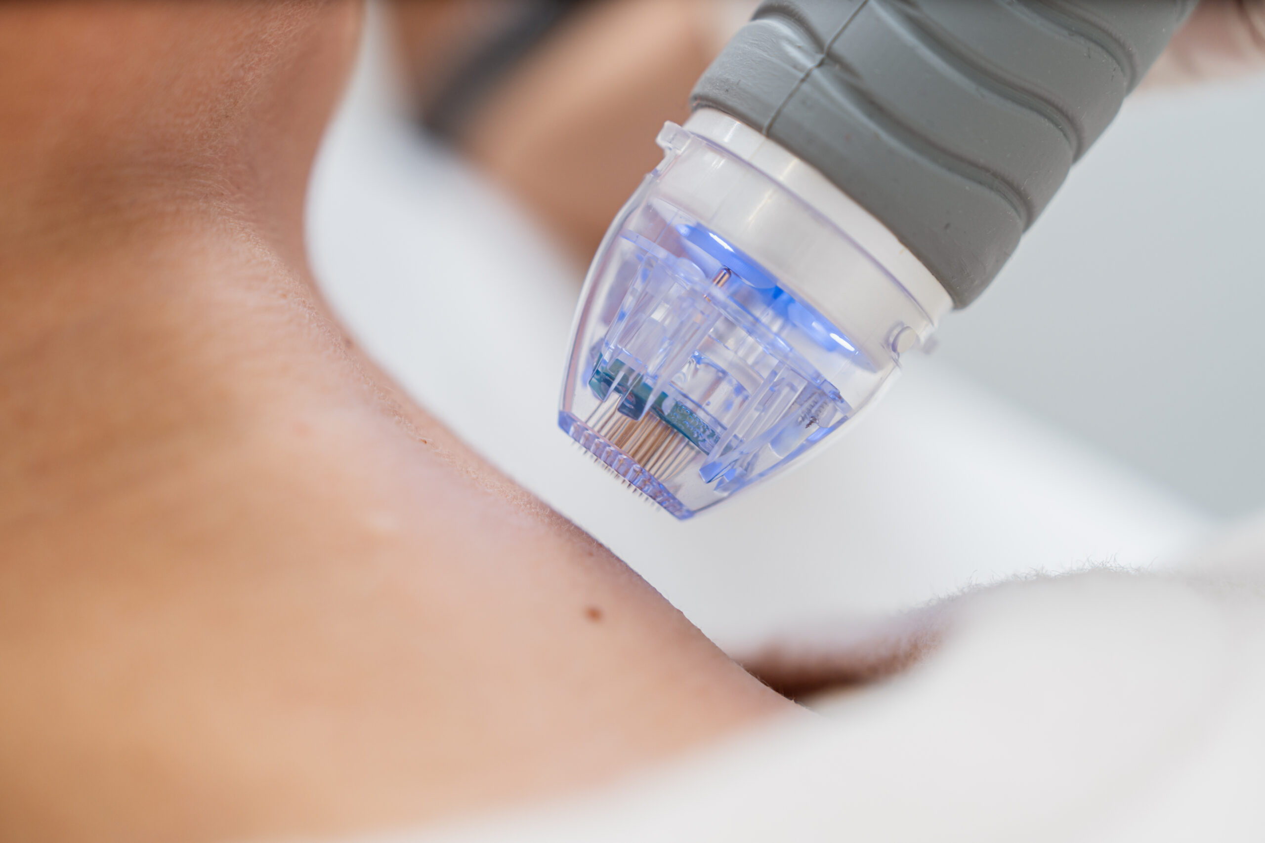 Microneedling step of a Vampire Facial creating micro-channels for PRP