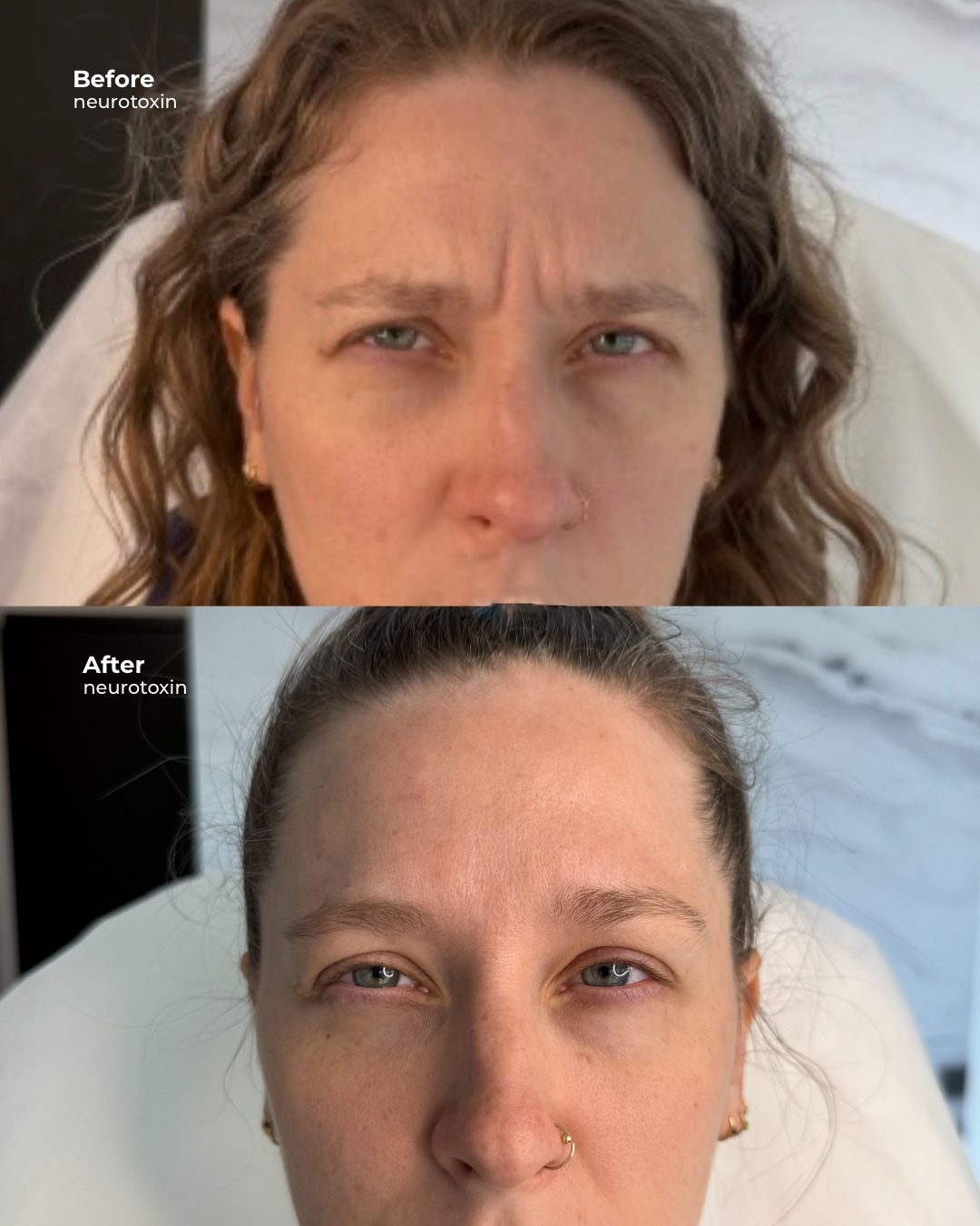 Botox for frown lines before and after, Bar Beauty Medical Toronto