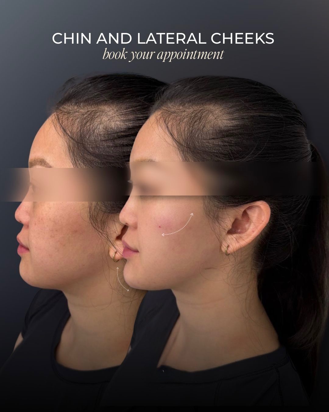 Chin and lateral cheek filler before and after profile, Bar Beauty Medical Toronto
