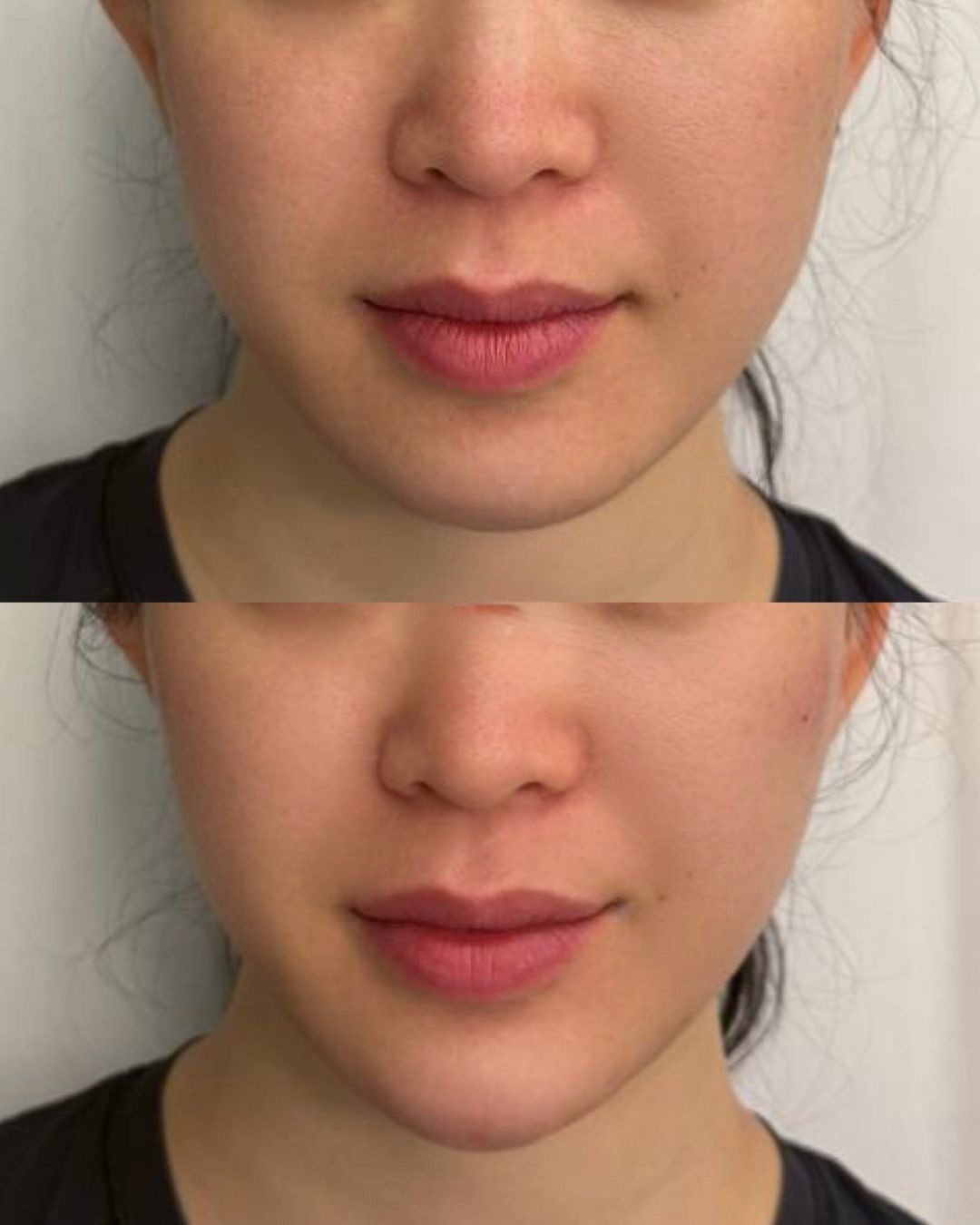 Chin filler before and after front view, Bar Beauty Medical Toronto