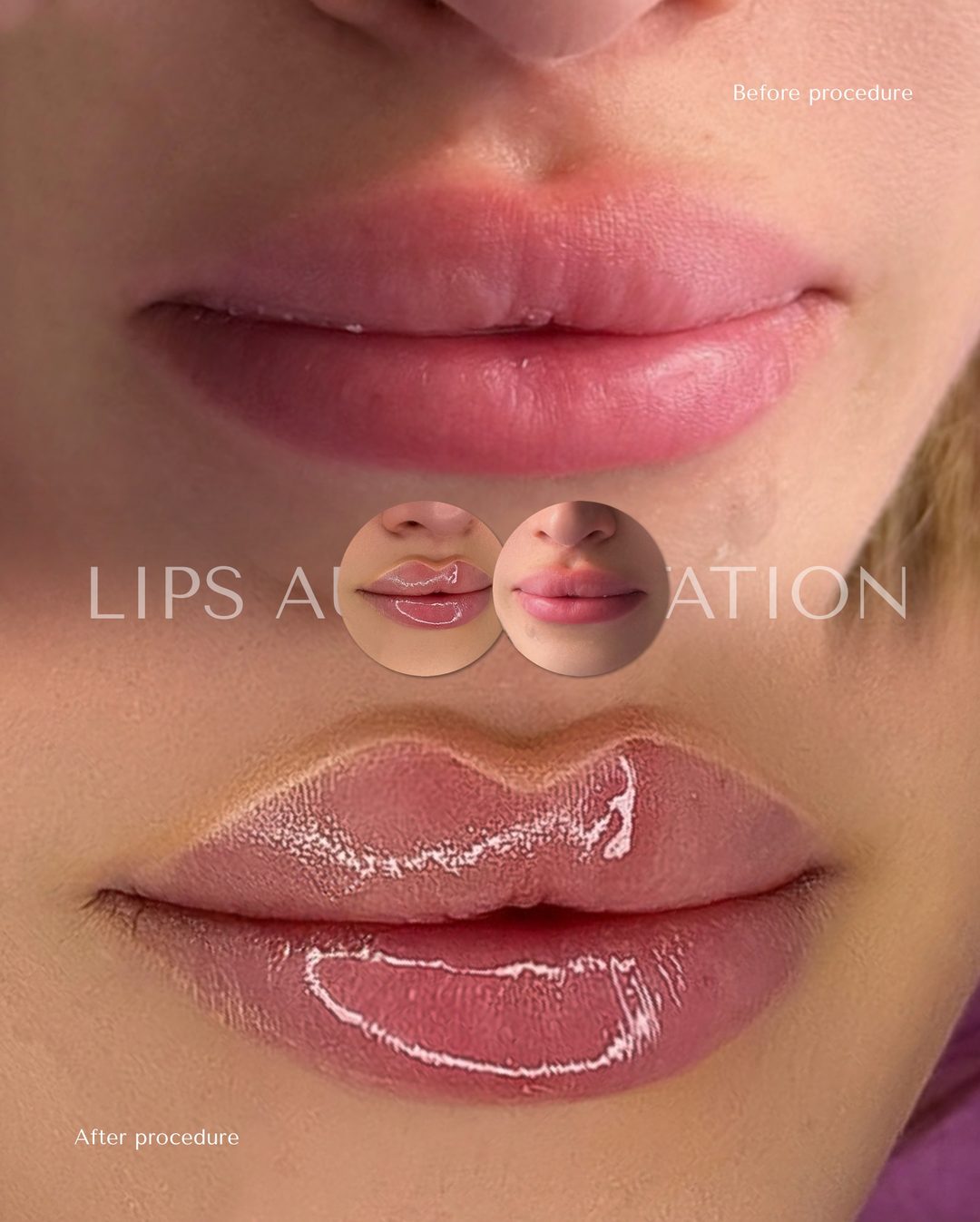 Lip filler before and after result at Bar Beauty Medical Toronto