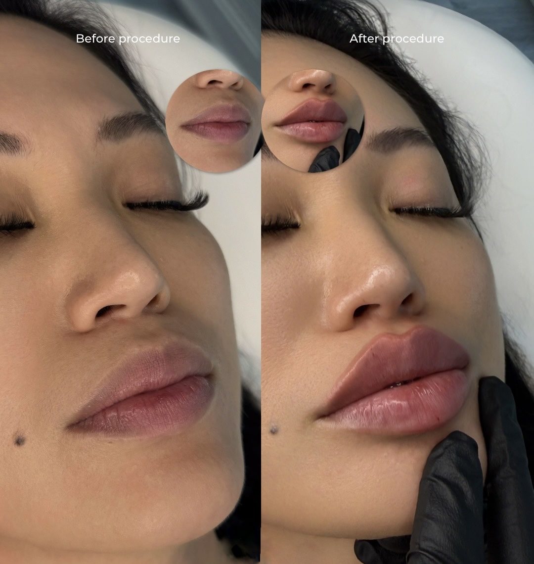 Lip filler before and after close up, Bar Beauty Medical Toronto