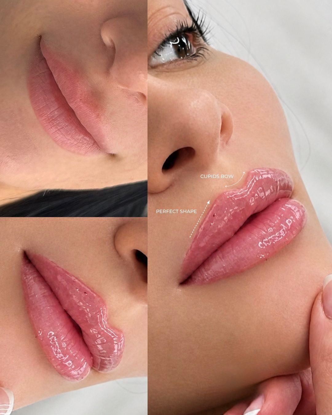Lip filler result from three angles, Bar Beauty Medical Toronto