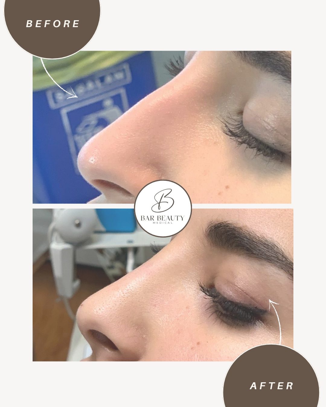 Liquid rhinoplasty before and after profile, Bar Beauty Medical Toronto