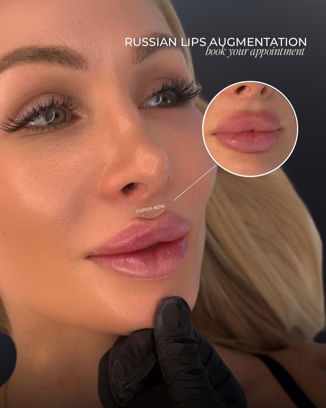 Russian lip technique result, Bar Beauty Medical Toronto
