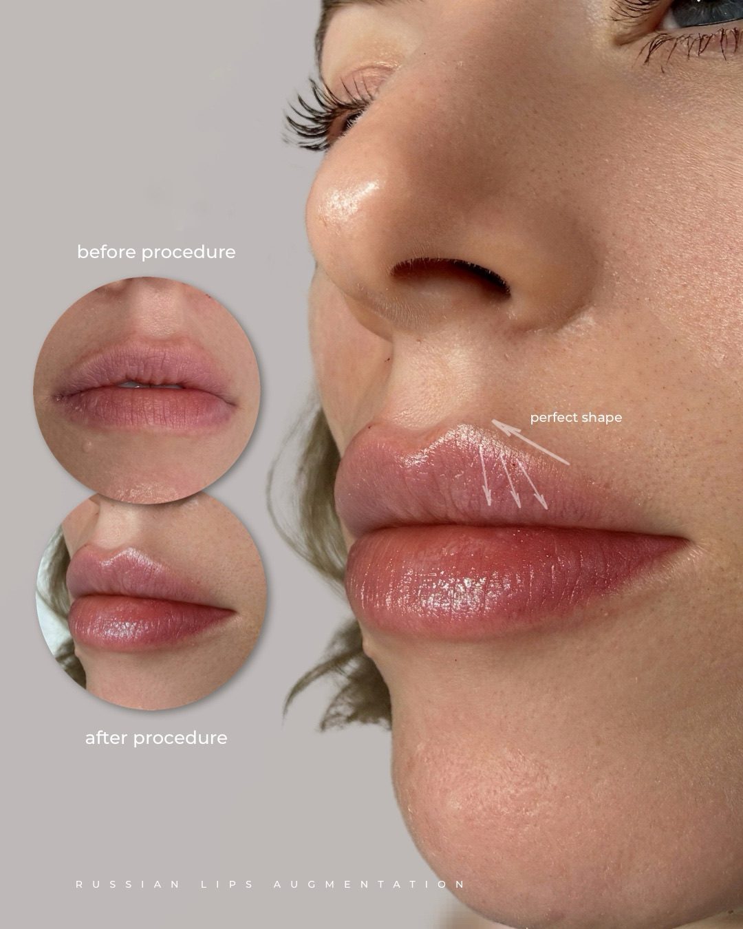 Russian lips augmentation before and after, Bar Beauty Medical Toronto