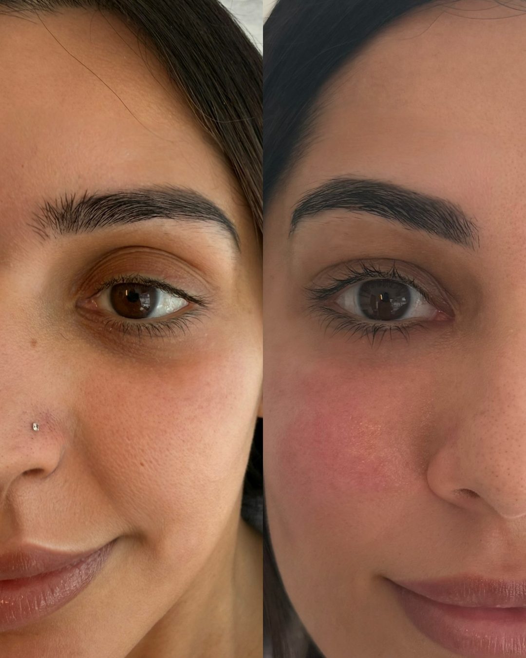 Under eye PRF before and after, Bar Beauty Medical Toronto