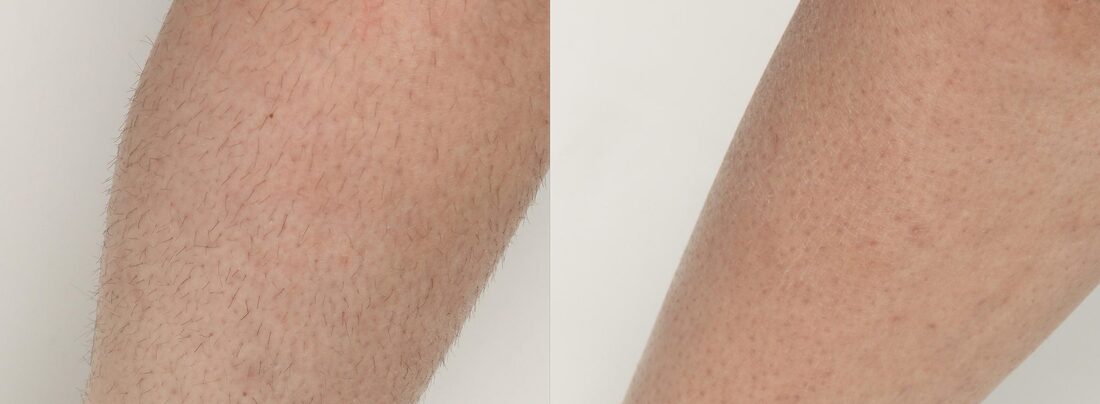 InMode Diolaze laser hair removal before and after