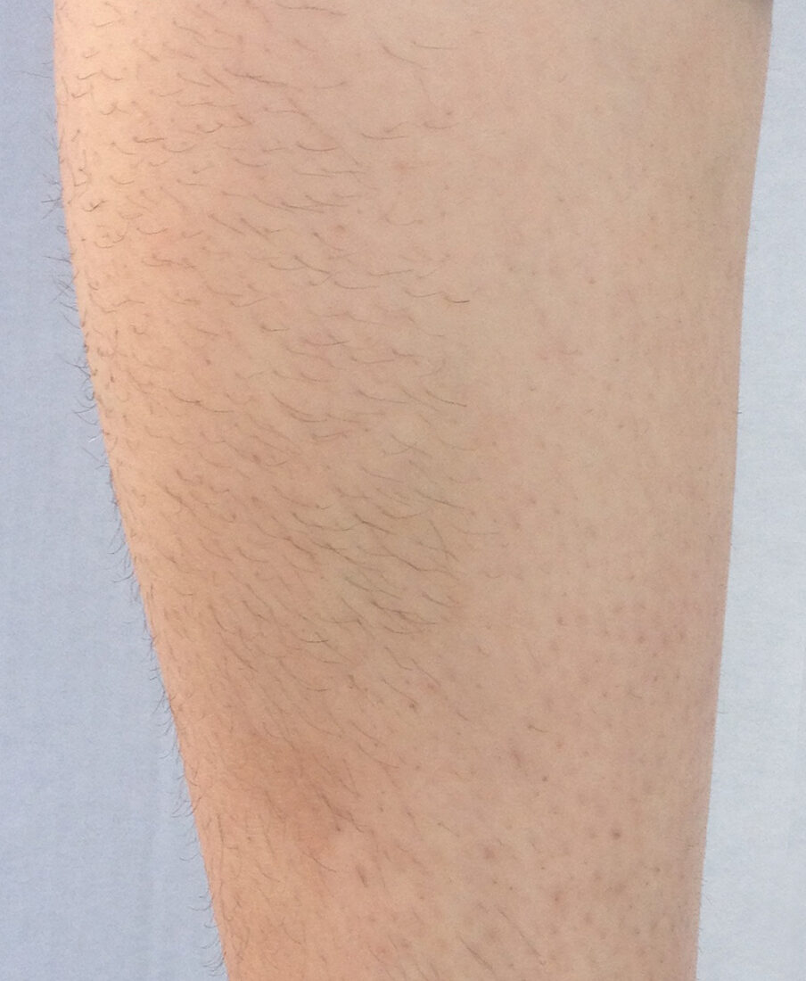 InMode Diolaze laser hair removal before and after