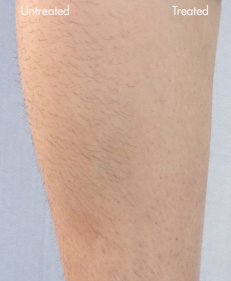 InMode Diolaze laser hair removal before and after