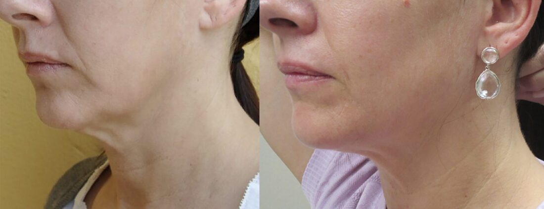 InMode Forma skin tightening before and after