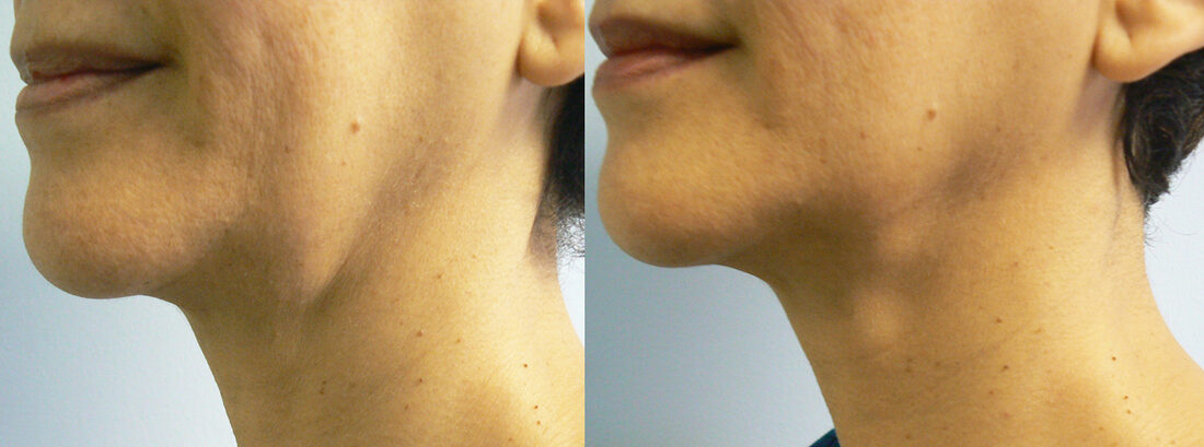 InMode Forma skin tightening before and after