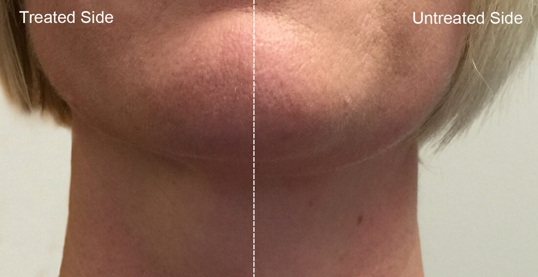 InMode Forma skin tightening before and after