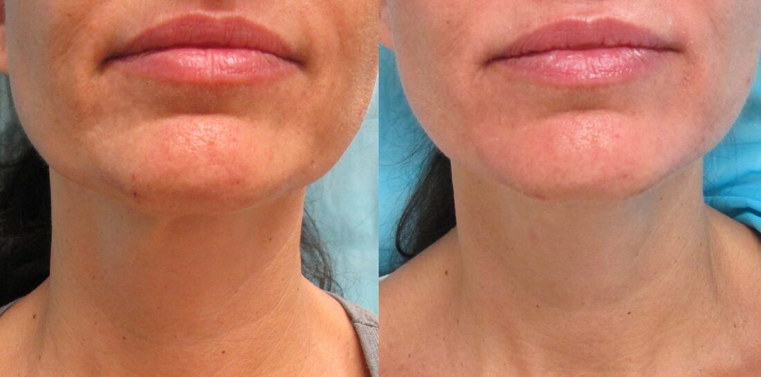 InMode Forma skin tightening before and after