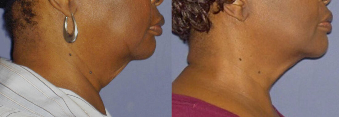 InMode Forma skin tightening before and after