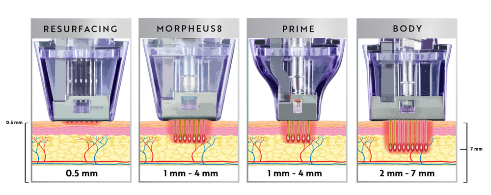Morpheus8 treatment depth diagram