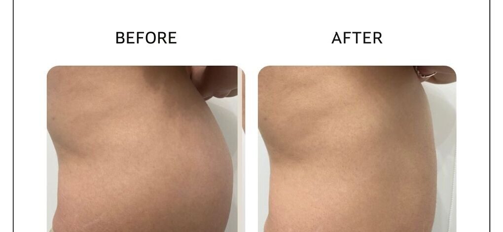 Venus Bliss fat reduction before and after