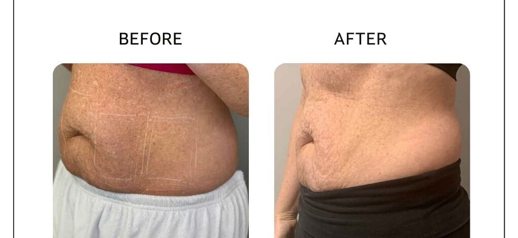 Venus Bliss before and after result