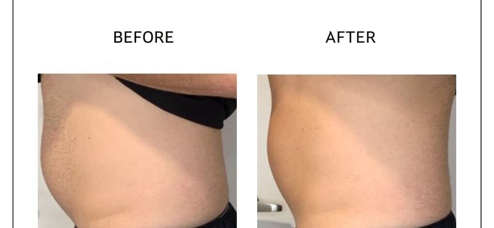 Venus Bliss before and after result