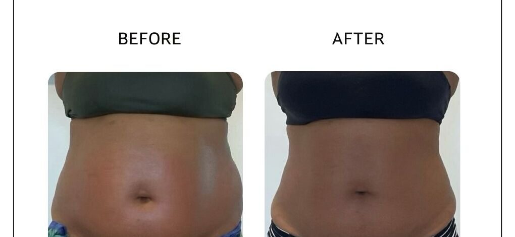Venus Bliss fat reduction before and after