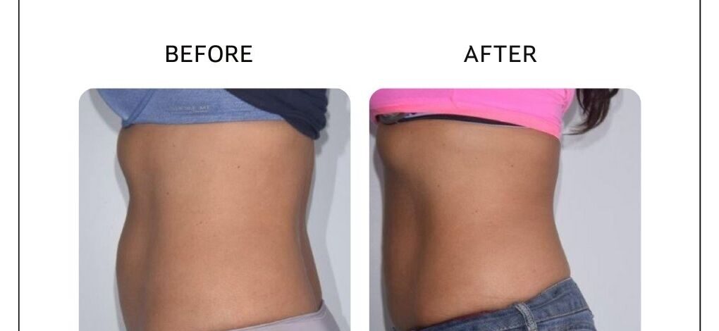 Venus Bliss body contouring before and after