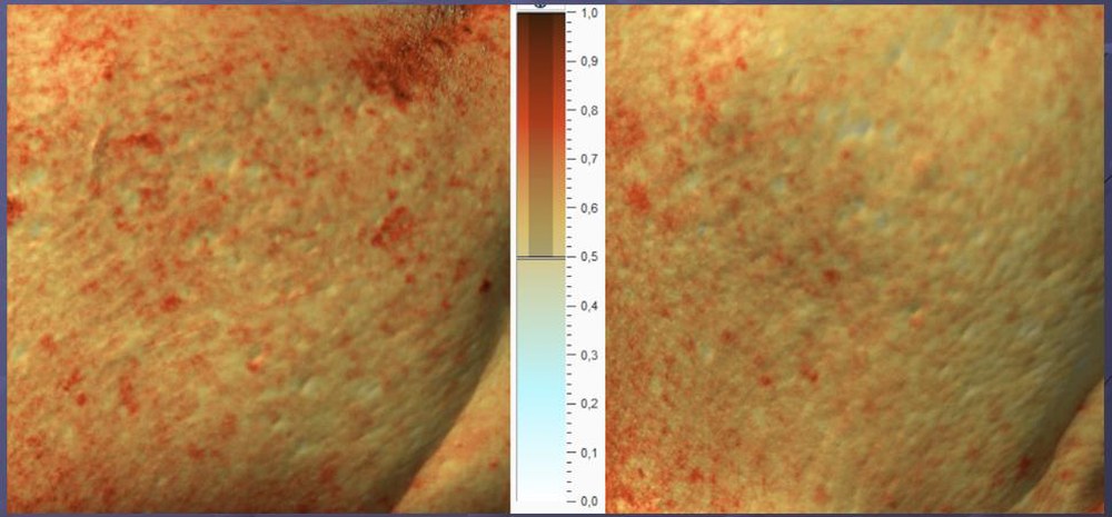 Antera 3D haemoglobin imaging before and after Pr&eacute;ime DermaFacial treatment