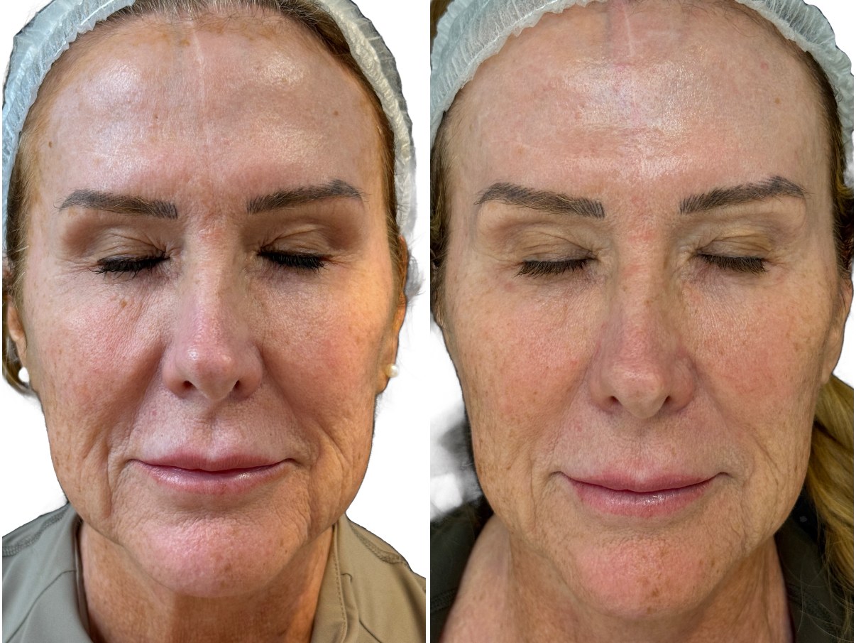 Before and after a Preime DermaFacial treatment showing improvement in fine lines and firmness. Manufacturer clinical image.
