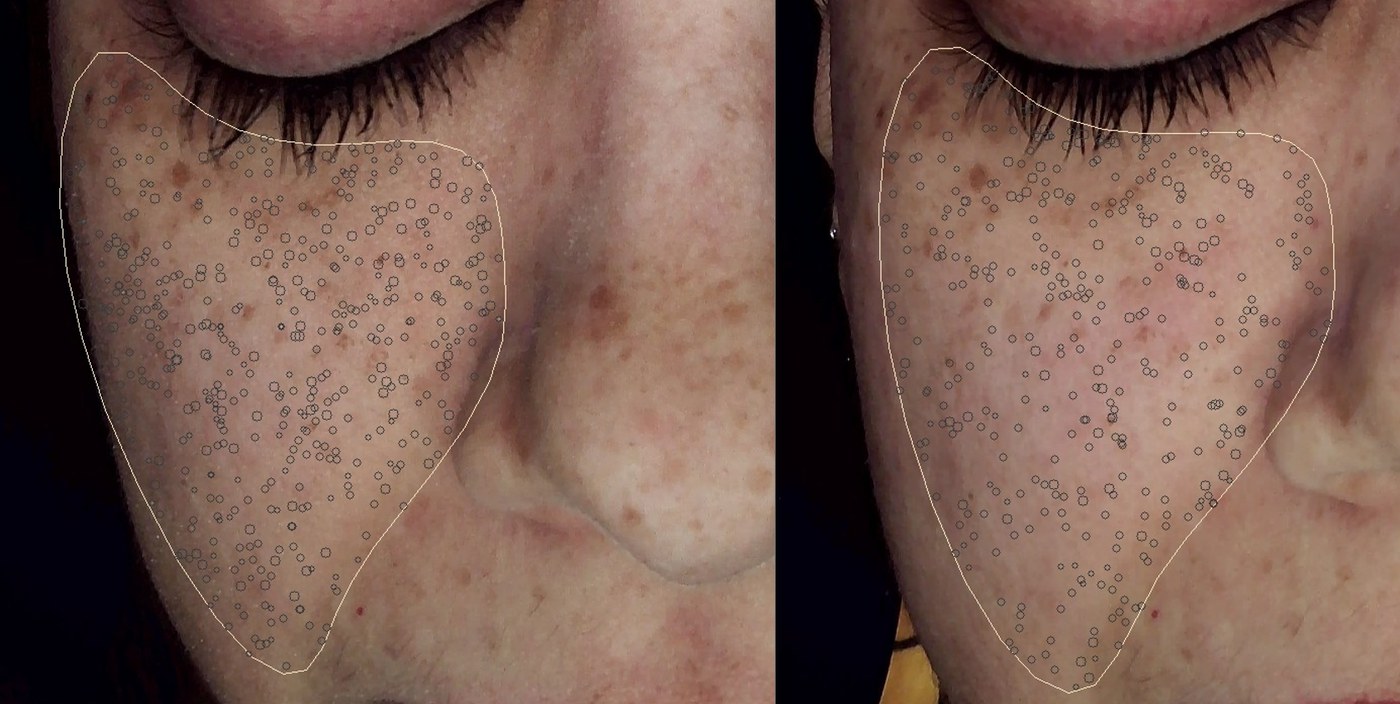 Before and after a Preime DermaFacial treatment showing reduction in surface pigmentation. Manufacturer clinical image.