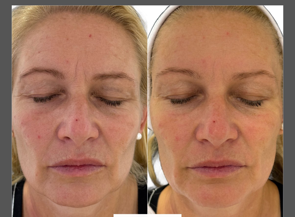 Before and after a Preime DermaFacial treatment showing improvement in skin tone and texture. Manufacturer clinical image.