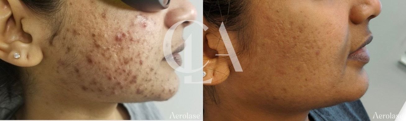 Acne, 3 treatments before and after with Aerolase Neo Elite, photo courtesy of Nina Harry, FNP