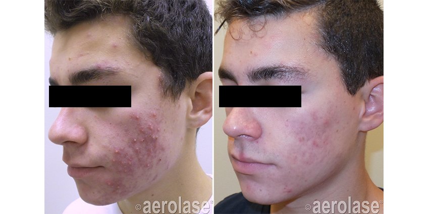 Acne, 4 treatments before and after with Aerolase Neo Elite, photo courtesy of Kevin Pinski, MD