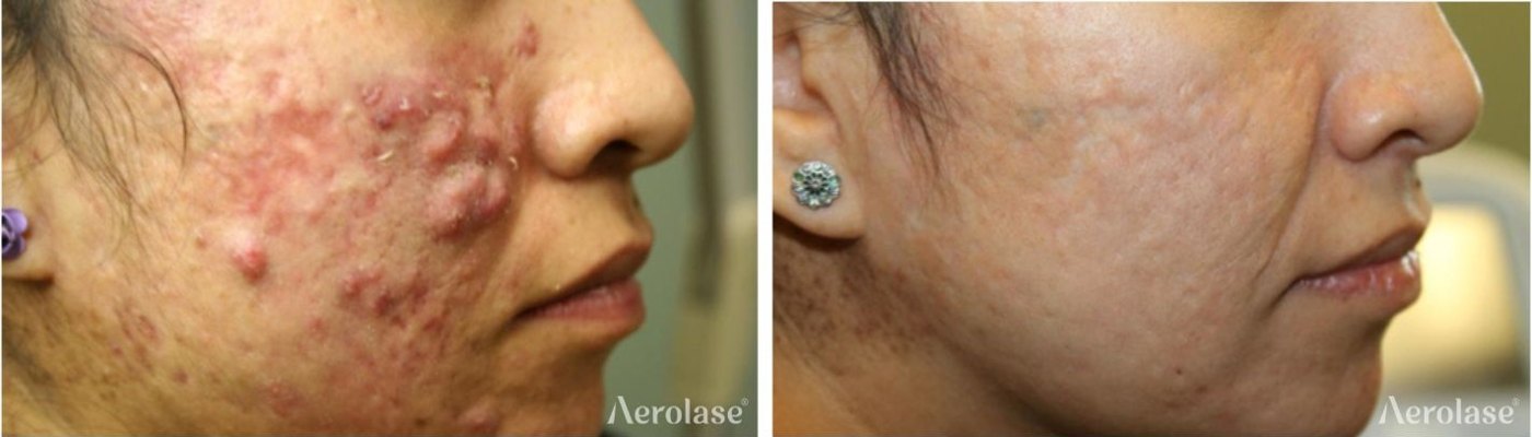 Acne, 5 treatments before and after with Aerolase Neo Elite, photo courtesy of Michael Gold, MD