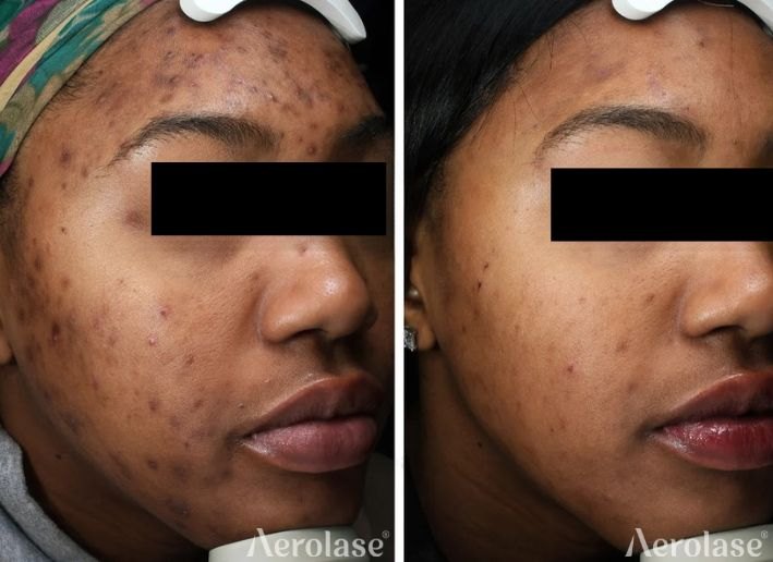 Acne with post-inflammatory hyperpigmentation, 5 treatments before and after with Aerolase Neo Elite, photo courtesy of Nazanin Saedi, MD
