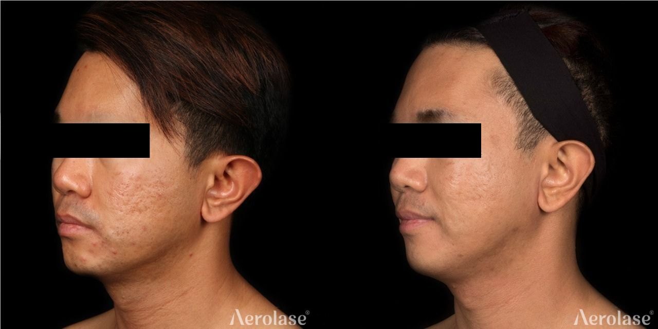 Acne scarring on the face before and after with Aerolase Neo Elite, photo courtesy of Jason Emer, MD