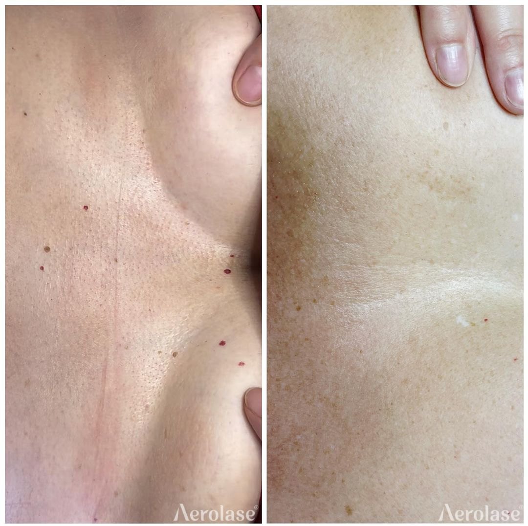 Cherry angiomas, 1 treatment before and after with the Aerolase Neo Elite, photo courtesy of Urban Retreat Derma Spa