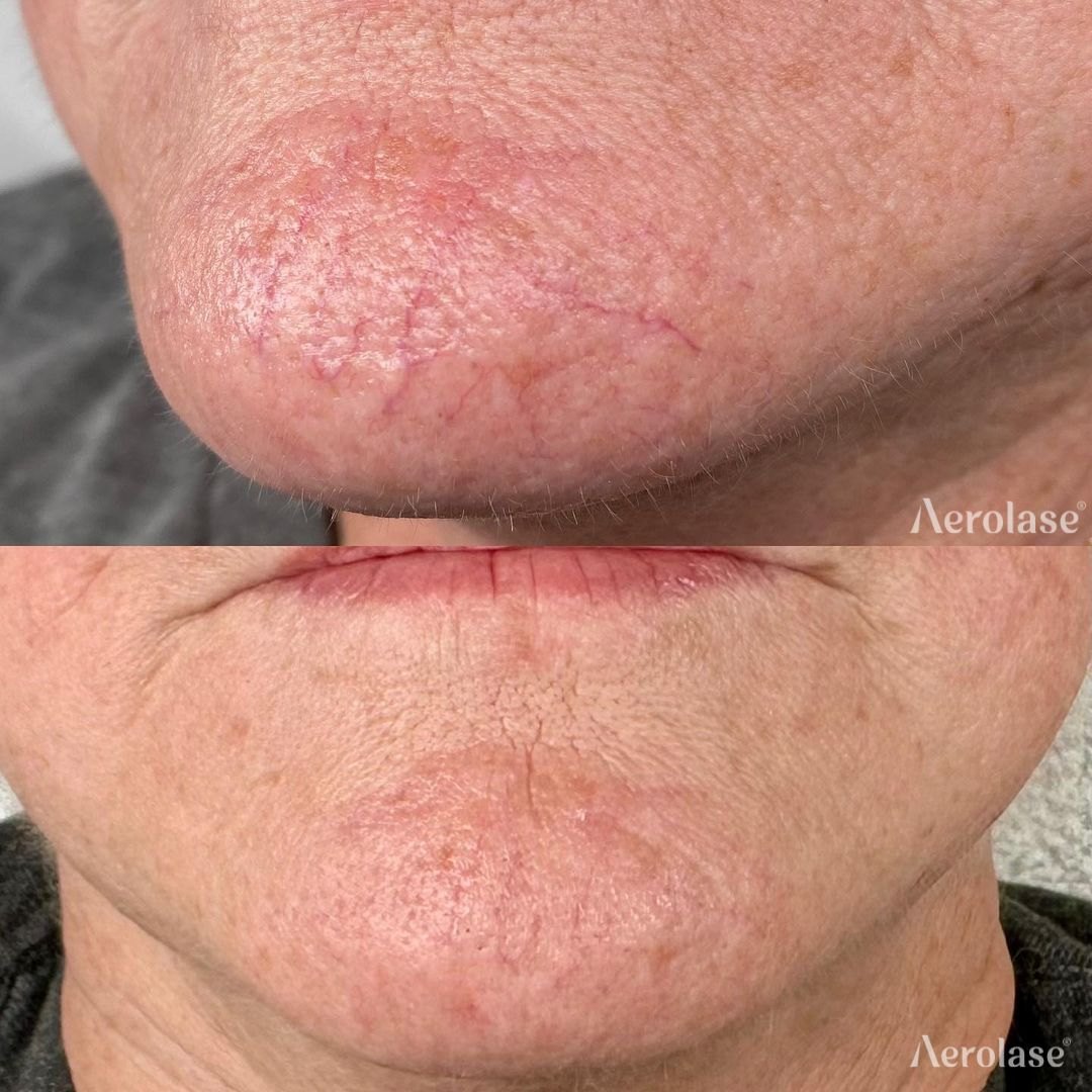 Facial spider veins, 1 treatment before and after with the Aerolase Neo Elite, photo courtesy of Bouq Skin