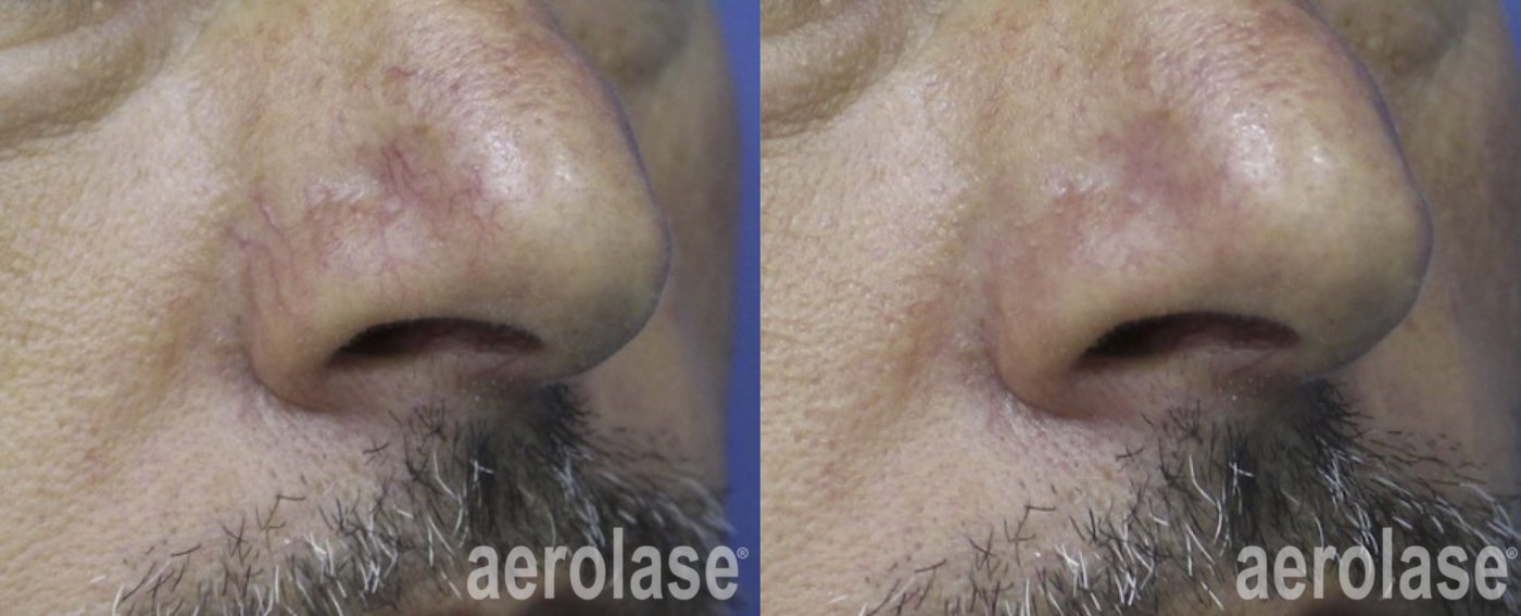 Facial veins before and after with Aerolase Neo Elite, photo courtesy of Dr Nabil Fakih