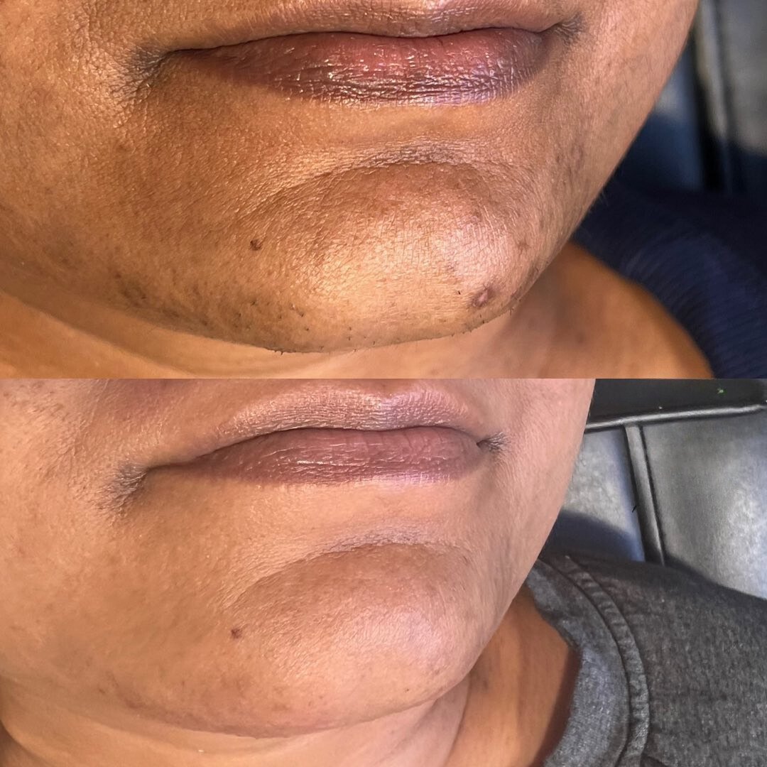 Hyperpigmentation before and after with Aerolase Neo Elite, photo courtesy of La Mone Aesthetics