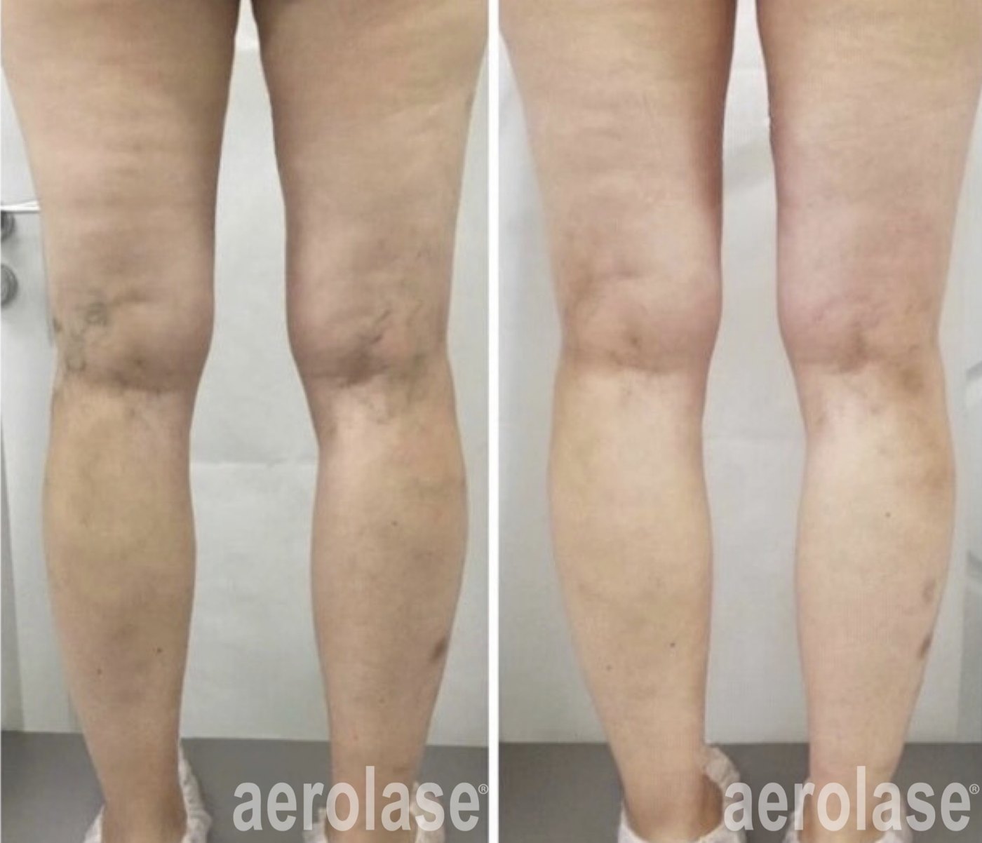 Leg veins before and after with the Aerolase Neo Elite, photo courtesy of Dr Dmitrii Rosykhovskii, MD