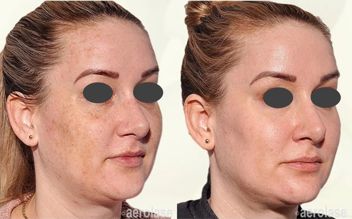 Melasma, 4 treatments before and after with the Aerolase Neo Elite, photo courtesy of Aerolase Corp.