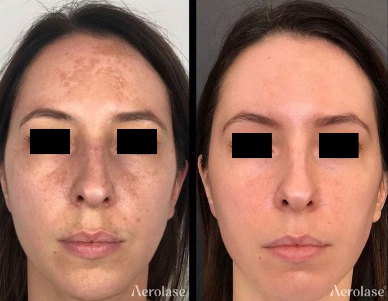 Melasma, 1 treatment before and after with Aerolase Neo Elite, photo courtesy of Avanti Aesthetic Academy