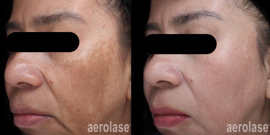 Melasma before and after with Aerolase Neo Elite, photo courtesy of Jason Emer, MD