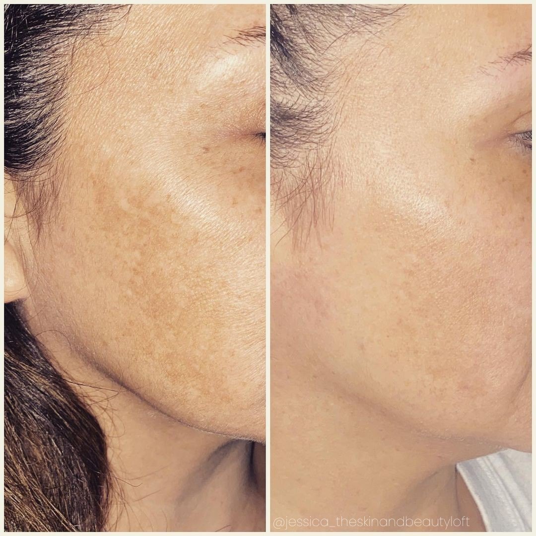 Melasma on the cheek before and after with the Aerolase Neo Elite, photo courtesy of The Skin & Beauty Loft