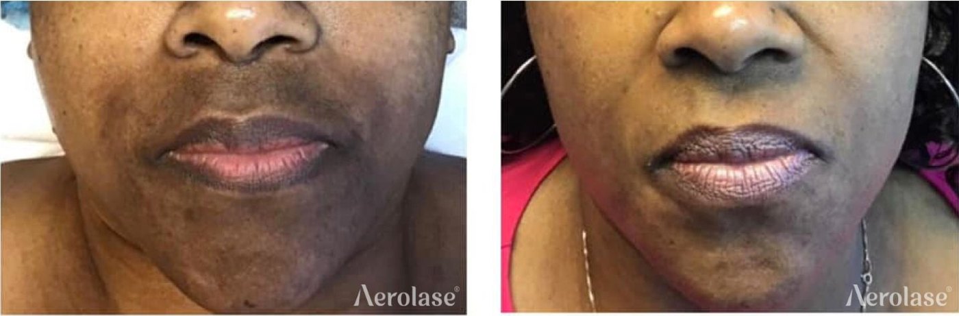 Melasma in deeper skin tones, 5 treatments before and after with the Aerolase Neo Elite, photo courtesy of Tiffany Crews