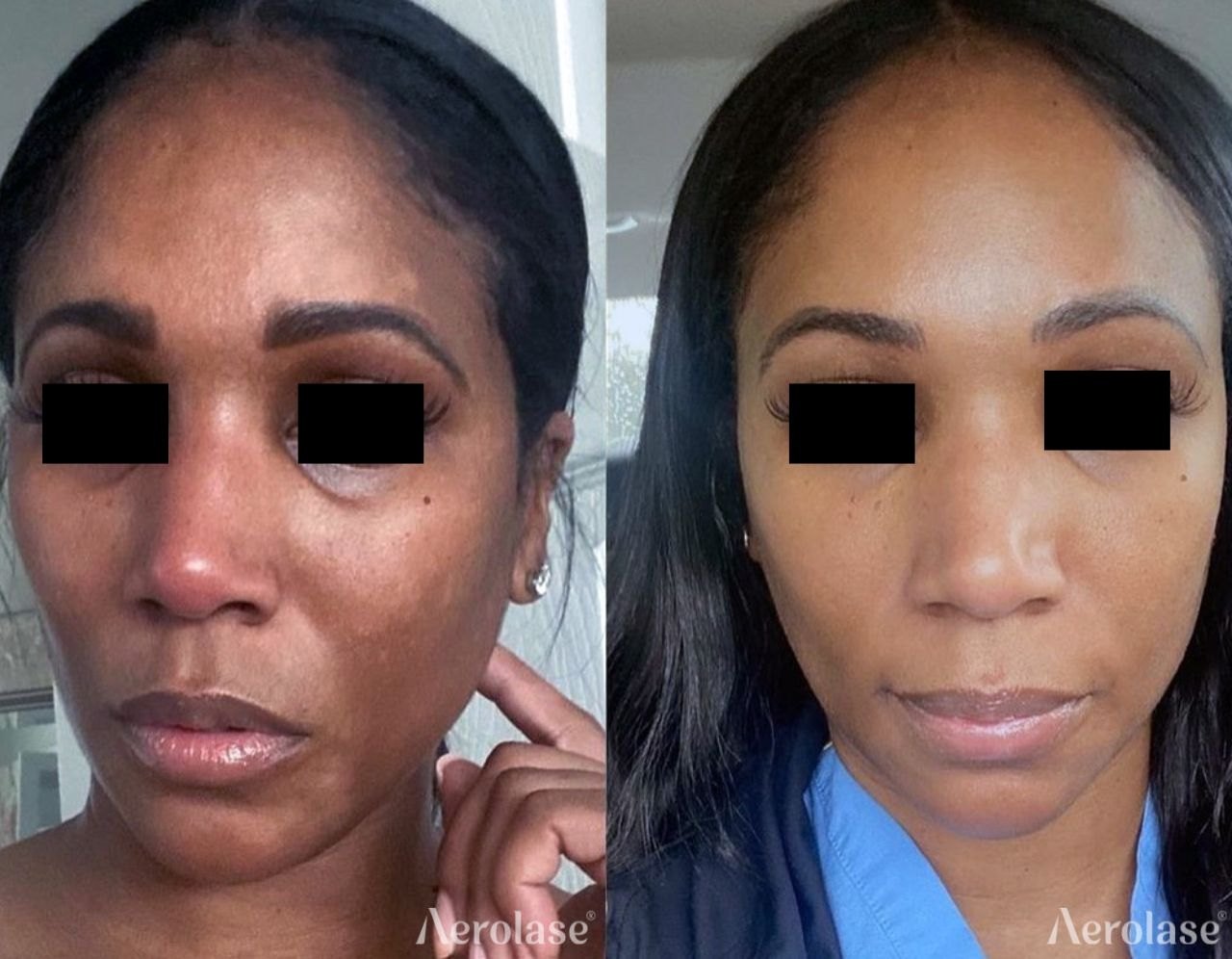 Melasma on the face before and after with the Aerolase Neo Elite, photo courtesy of LaMone Aesthetics