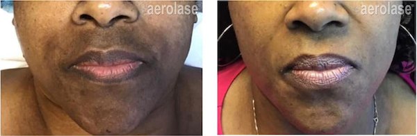 Melasma in skin of colour, 5 treatments before and after with Aerolase Neo Elite, photo courtesy of Tiffany Crews
