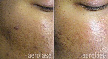 Pigmented spots before and after with the Aerolase Neo Elite, photo courtesy of Aerolase Corp.