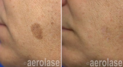 Pigmented spots on the face before and after with the Aerolase Neo Elite, photo courtesy of Aerolase Corp.