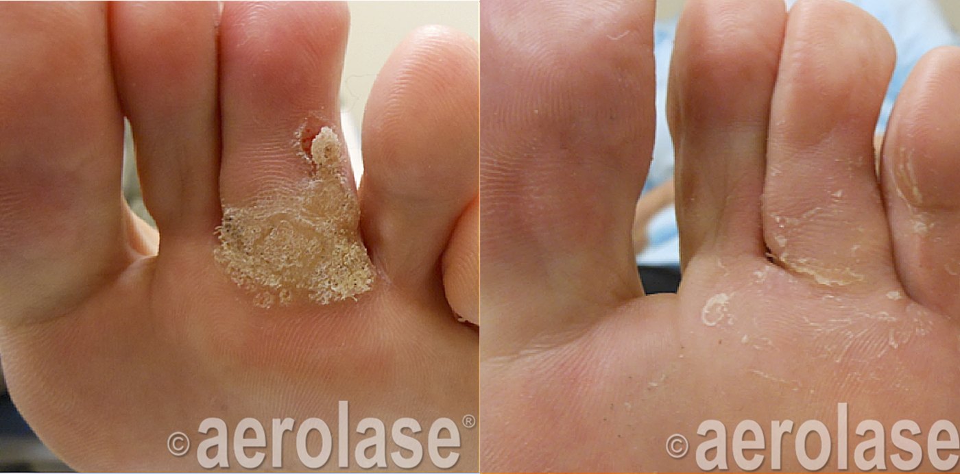 A plantar wart on the foot before and after with the Aerolase Neo Elite, photo courtesy of Marc Garfield, DPM